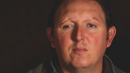 A head shot of blind veteran Chris, a healed scar is showing along his brow line, highlighting an injury he received during his time in service.