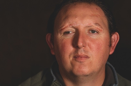 A head shot of blind veteran Chris, a healed scar is showing along his brow line, highlighting an injury he received during his time in service.